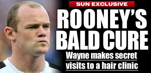 SECRETUL lui Rooney a fost DESCOPERIT! L-au prins in timp ce-si facea implanturi!_1