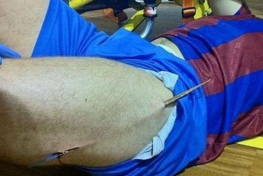Toata Barcelona a inlemnit! Un fotbalist s-a ales cu o aschie de jumatate de metru in picior! Vezi ce s-a intamplat:_2