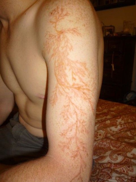 FOTO Tatuaj NATURAL! N-ai mai vazut asa ceva pana acum! Cum se transforma pielea unui om lovit de fulger:_1