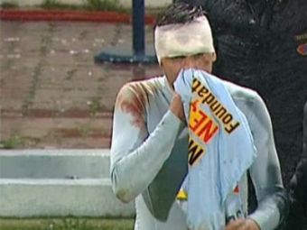 
	FOTO HORROR: Accidentarea de aseara il va lasa pe Rusescu cu un SEMN PE VIATA! Cum arata dupa ce a fost taiat pe frunte cu crampoanele:
