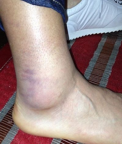 Accidentare HORROR pentru Falcao! Colegii s-au speriat cand au vazut cum arata piciorul lui! Ce a patit atacantul de 60mil €:_2