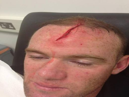 Rooney, accidentare teribila! Prima poza HORROR cu atacantul dupa ce si-a spart capul! Englezul a mai patit-o odata!_2