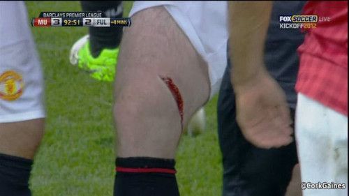 Rooney, accidentare teribila! Prima poza HORROR cu atacantul dupa ce si-a spart capul! Englezul a mai patit-o odata!_3