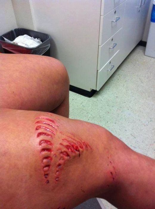 INGROZITOR! Cum arata piciorul unei femei care a fost muscata de un rechin! Imaginea care te va INGROZI!_2