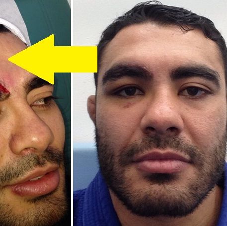 Un luptator a suferit o accidentare HORROR! E cea mai urata taietura din istoria MMA: "Am avut nevoie de 30 de copci" FOTO_1