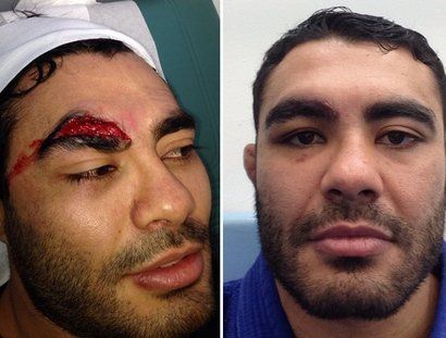 Un luptator a suferit o accidentare HORROR! E cea mai urata taietura din istoria MMA: "Am avut nevoie de 30 de copci" FOTO_2