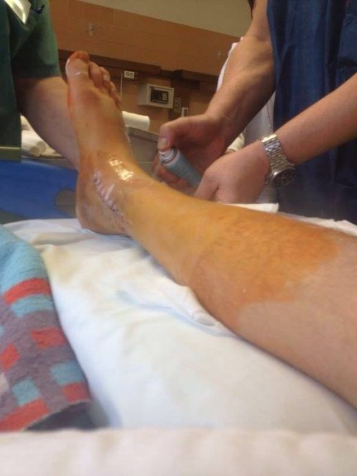 FOTO EXCLUSIV! Dan Roman s-a operat dupa accidentarea horror! Cum arata piciorul lui dupa operatie:_1