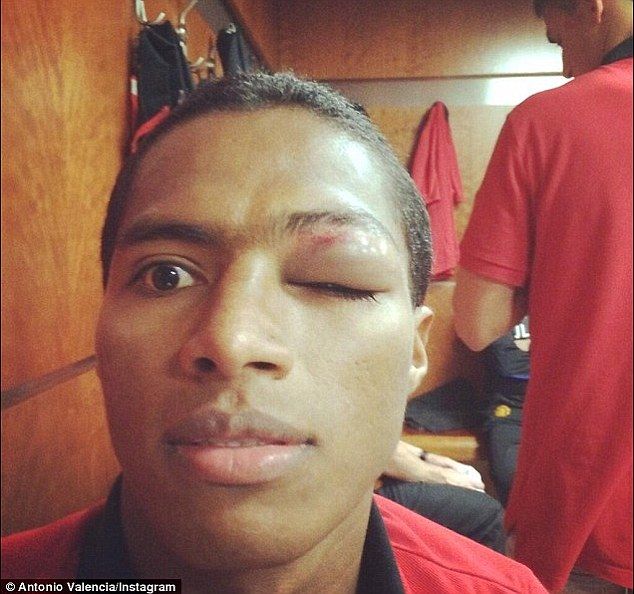 Imagine HORROR la meciul revenirii lui Chiriches! Un fost star de de la United s-a ales cu un ochi vanat! FOTO_4