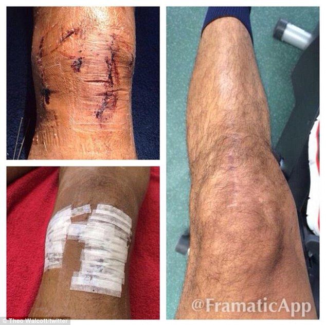 Cum arata acum piciorul lui Walcott, dupa accidentarea groaznica ce i-a sters orice sansa de a mai juca la Mondial. FOTO SOCANT_1