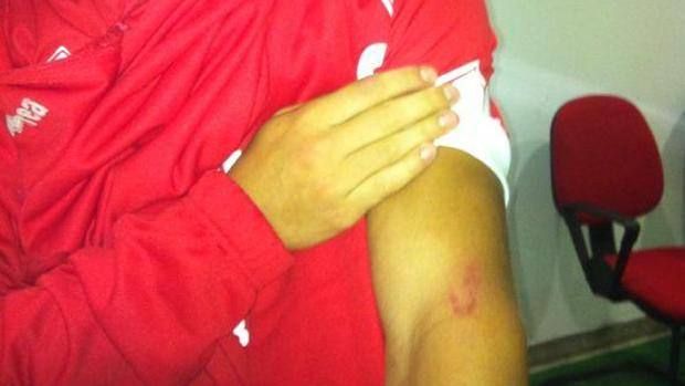 FOTO: Un nou caz SUAREZ in fotbal sub ochii unui ROMAN! Cum arata mana acestui fotbalist dupa ce a fost muscat pe teren_1
