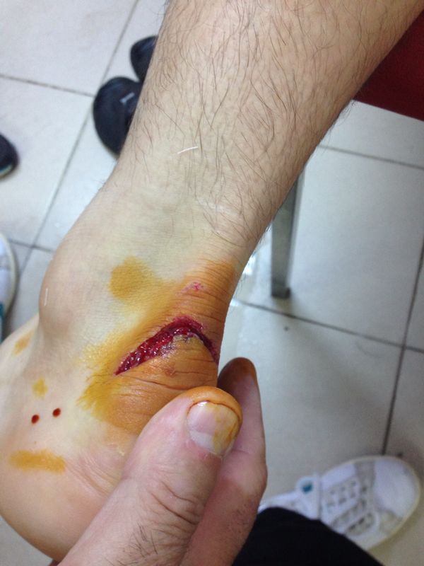 "Accidentarea lui Bilinski este foarte grava, trebuie sa aducem alt atacant!" FOTO HORROR: Cum arata piciorul golgheterului_2