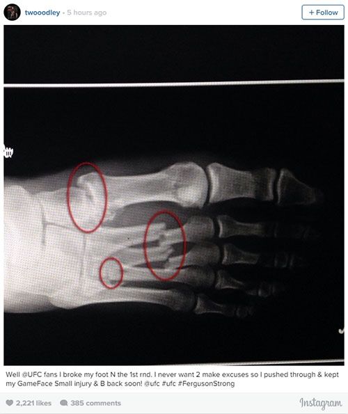 Si-a rupt piciorul in PATRU locuri, dar a continuat si castigat meciul! Cum arata radiografia acestui sportiv dupa un meci de MMA: FOTO uimitor_1