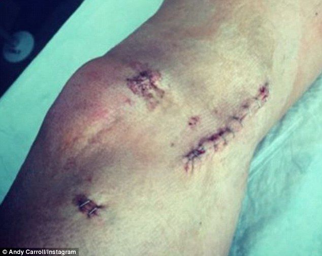 IMAGINI SOCANTE! Cum arata in acest moment piciorul lui Andy Carroll, dupa ce s-a operat. Va rata tot restul sezonului. FOTO_5