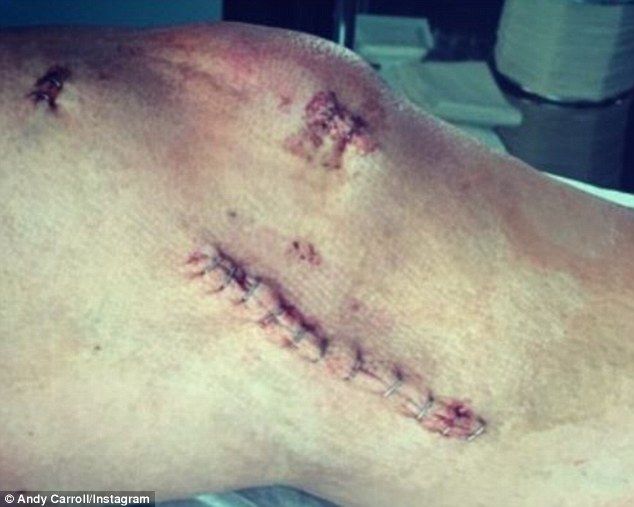 IMAGINI SOCANTE! Cum arata in acest moment piciorul lui Andy Carroll, dupa ce s-a operat. Va rata tot restul sezonului. FOTO_7