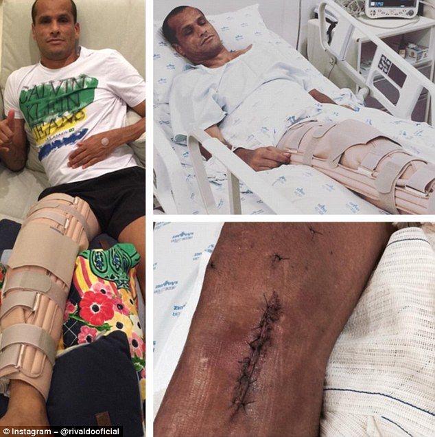 Imagini horror cu Rivaldo! S-a retras din fotbal la 43 de ani si s-a operat de urgenta! Cum arata acum piciorul lui. FOTO_1