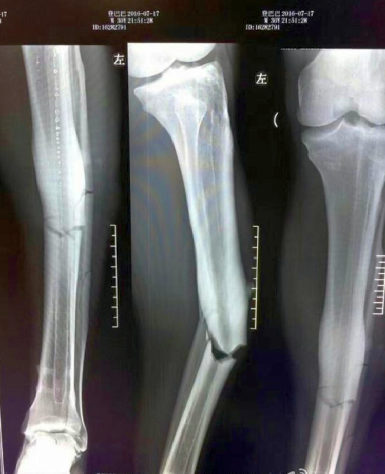 FOTO SOCANT. Cum arata radiografia piciorului lui Demba Ba, dupa accidentarea groaznica suferita in China. Cariera atacantului este in pericol_1