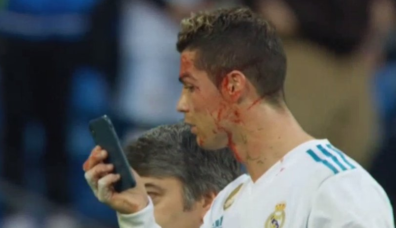 RONALDO, APARITIE SOC // Cum arata Cristiano Ronaldo dupa ce a iesit insangerat de pe teren la meciul cu Deportivo. FOTO_3