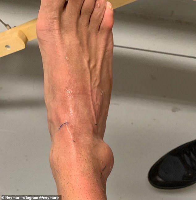 FOTO Cum arata piciorul lui Neymar dupa accidentarea grava de la nationala! Cariera starului de 27 de ani, in pericol!_2