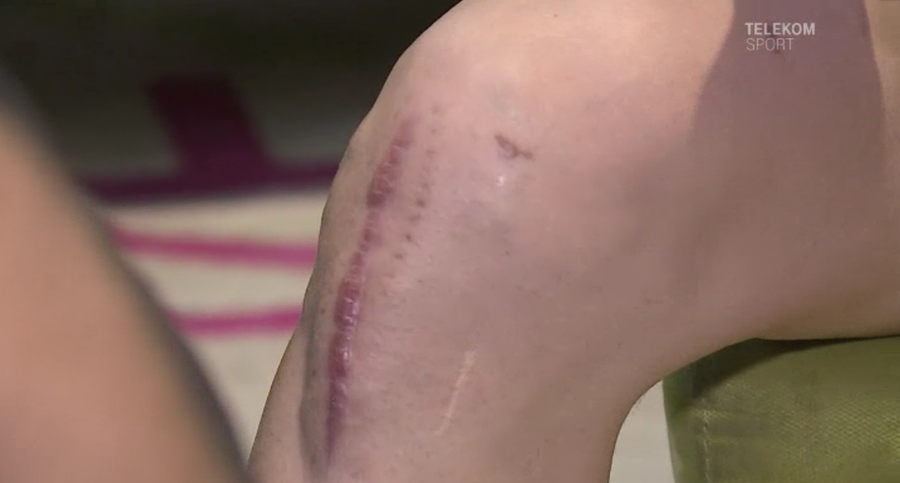 Imagini care cu greu pot fi privite! Piciorul lui Gardos arata INFIORATOR dupa doua operatii la genuchi: "M-am gandit sa ma retrag"_2