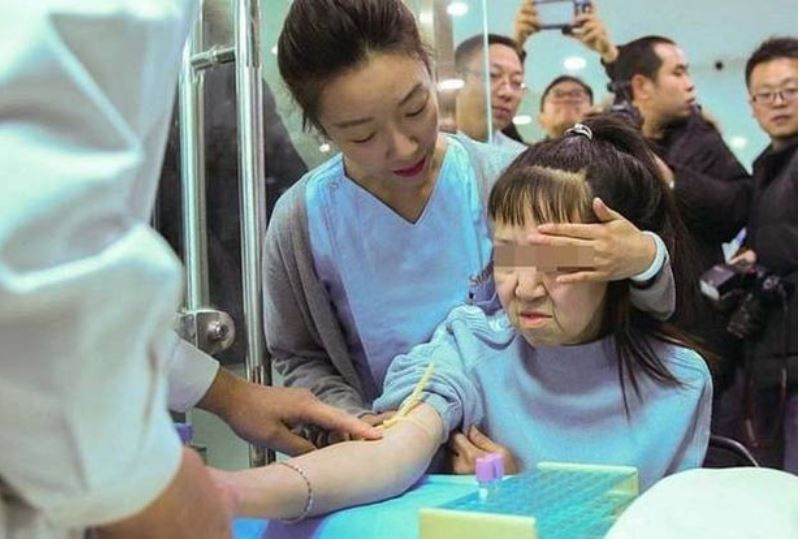 Batjocorita la scoala pentru ca arata batrana din cauza unei boli rare, o fetita din China a primit un transplant de fata! Cum arata acum_1