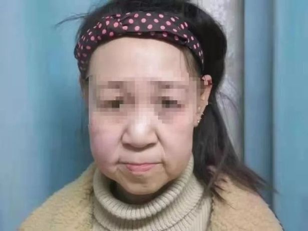 Batjocorita la scoala pentru ca arata batrana din cauza unei boli rare, o fetita din China a primit un transplant de fata! Cum arata acum_4