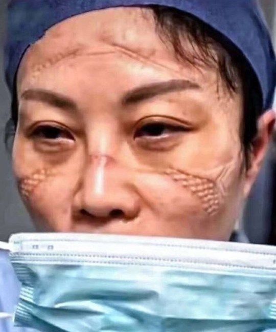 IMAGINI SOCANTE! Medicii care ii trateaza pe chinezi de coronavirus, desfigurati de la echipamentul de protectie: "Sunt epuizati!"_2