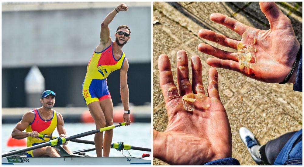 Suferințele din spatele unei medalii olimpice | Poza cu palmele lui Ciprian Tudosă, dovada sacrificiilor uriașe_1