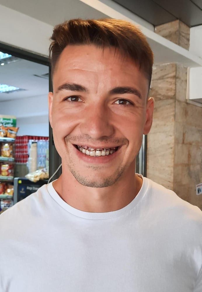FOTO | Alex Mateiu, cu sârme și șuruburi în gură. Cum arată la o săptămână după incidentul din partida cu Gaz Metan _6