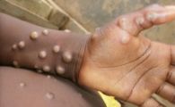 Noi cazuri de variola maimuțelor . Cu ce simptome se confruntă bolnavii și cum se transmite infecția virală