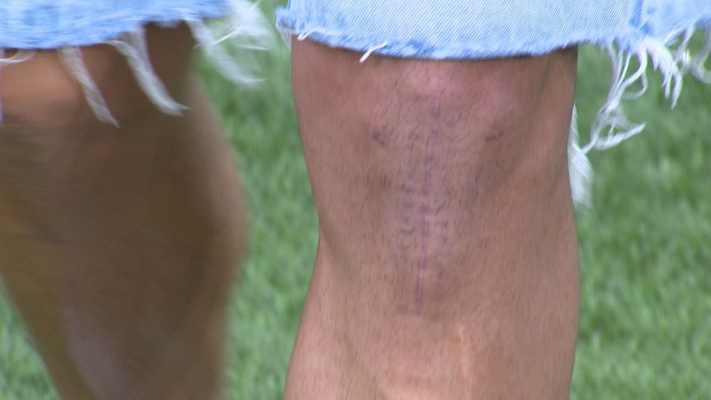 Cum arată genunchiul lui Iulian Cristea, la mai bine de o lună după accidentare_1
