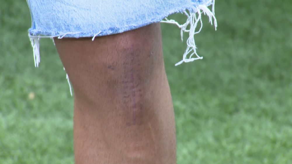 Cum arată genunchiul lui Iulian Cristea, la mai bine de o lună după accidentare_2