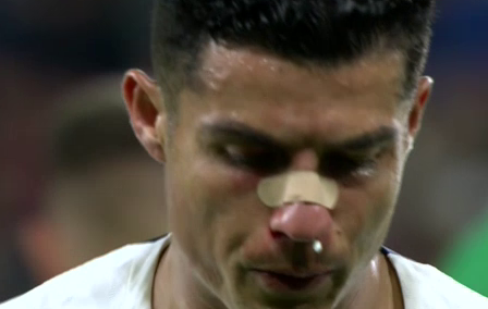 Cristiano Ronaldo, umplut de sânge în meciul Cehia - Portugalia!_11