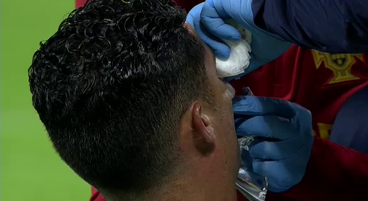 Accidentarea care l-a umplut de sânge a lăsat urme pe fața lui Cristiano Ronaldo! Cum a apărut azi portughezul _16