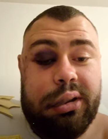 „Brutalitate extremă!” Românul care și-a desfigurat fața pentru 5.000 de euro la concursul de pălmuit a ajuns în presa internațională! Ce scriu spaniolii _9