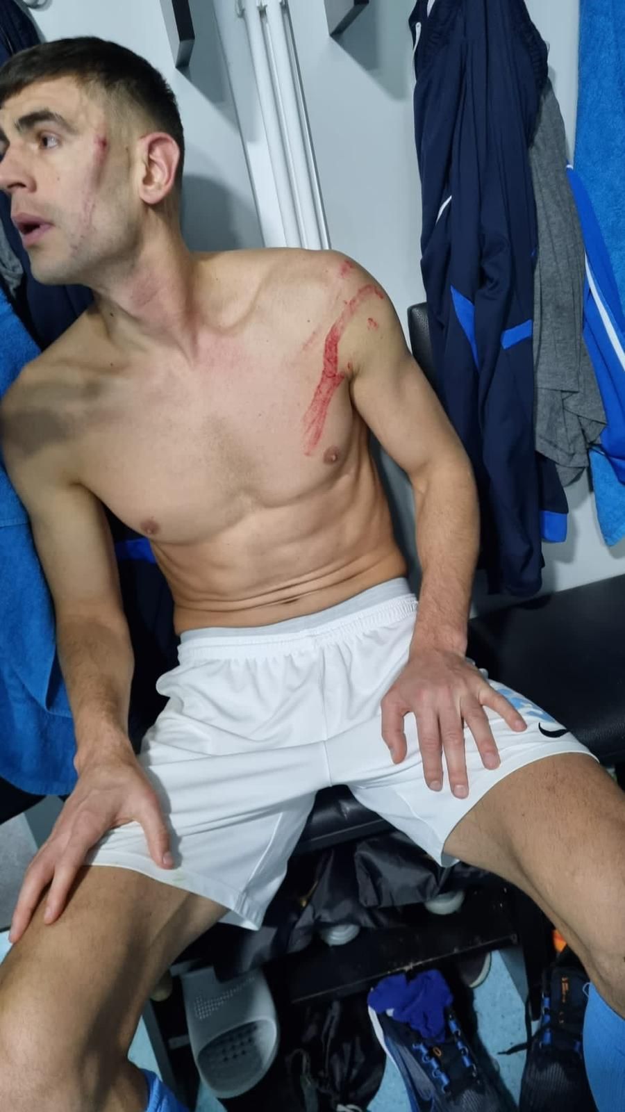 Imagini incredibile! Cum arată fața lui Igor Armaș după piciorul în cap primit de la Edjouma_2