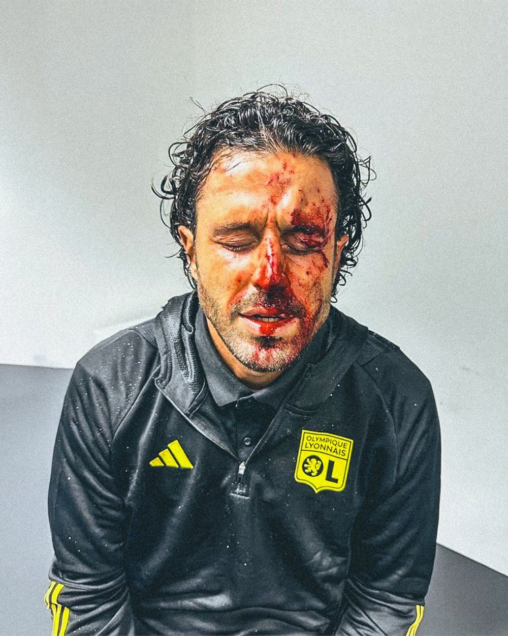 "Încă mai are cioburi pe față". Detalii teribile despre antrenorul lui Lyon, după ce autocarul echipei a fost atacat cu pietre_6