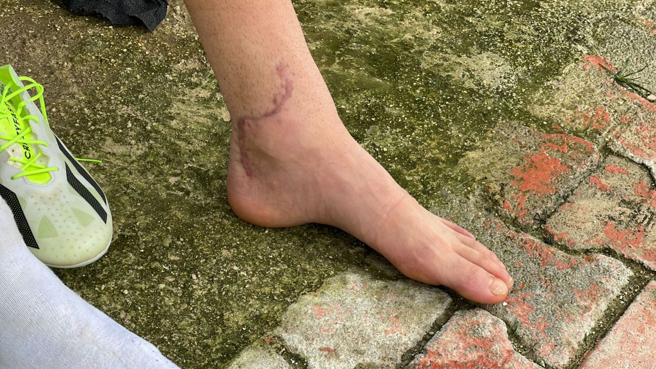 Cum arată piciorul lui Dragoș Iancu la trei luni și jumătate după accidentarea horror de la Ploiești_1