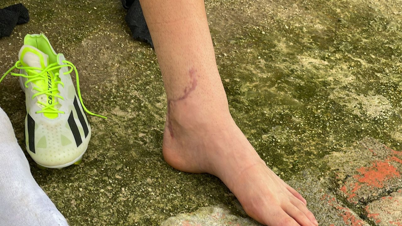 Cum arată piciorul lui Dragoș Iancu la trei luni și jumătate după accidentarea horror de la Ploiești_2