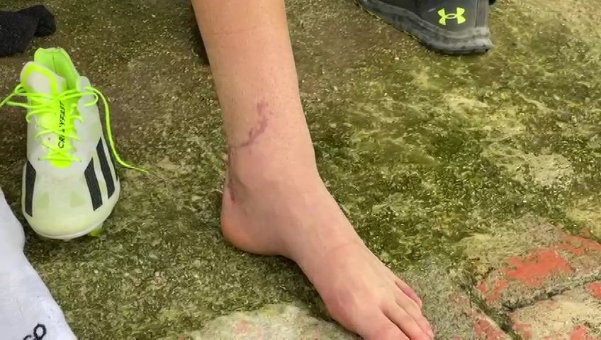 Cum arată piciorul lui Dragoș Iancu la trei luni și jumătate după accidentarea horror de la Ploiești_13