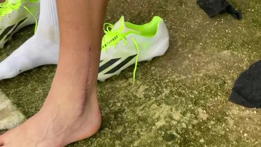 Cum arată piciorul lui Dragoș Iancu la trei luni și jumătate după accidentarea horror de la Ploiești_14