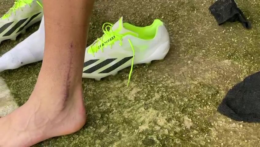 Cum arată piciorul lui Dragoș Iancu la trei luni și jumătate după accidentarea horror de la Ploiești_15