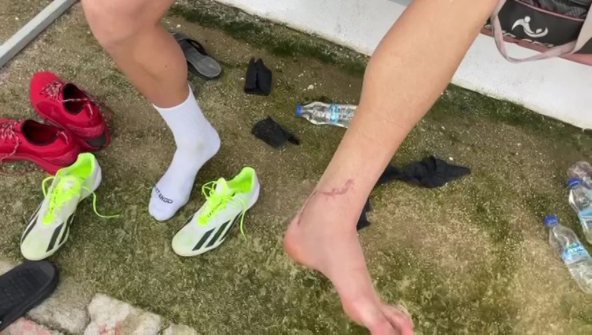 Cum arată piciorul lui Dragoș Iancu la trei luni și jumătate după accidentarea horror de la Ploiești_9