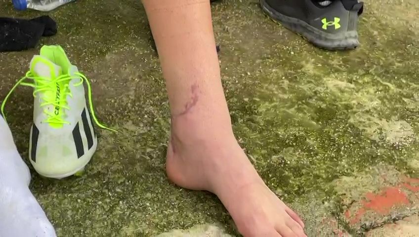 Cum arată piciorul lui Dragoș Iancu la trei luni și jumătate după accidentarea horror de la Ploiești_12